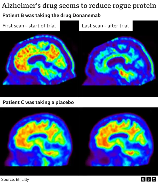 New Dementia Drug